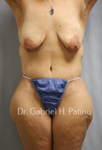  Before and After Cosmetic Surgery in Oakland, CA 