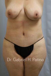  Before and After Cosmetic Surgery in Oakland, CA 