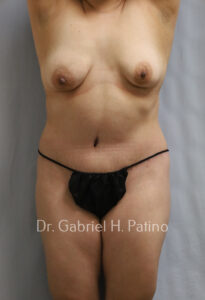  Before and After Cosmetic Surgery in Oakland, CA 