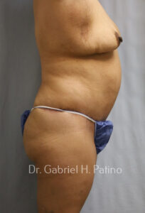  Before and After Cosmetic Surgery in Oakland, CA 