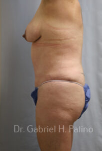  Before and After Cosmetic Surgery in Oakland, CA 