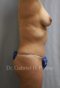  Before and After Cosmetic Surgery in Oakland, CA 