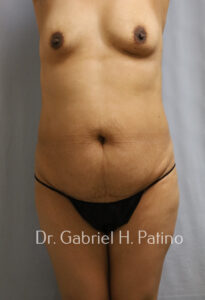  Before and After Cosmetic Surgery in Oakland, CA 