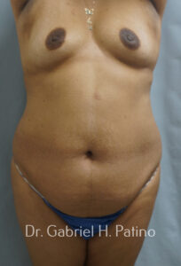  Before and After Cosmetic Surgery in Oakland, CA 