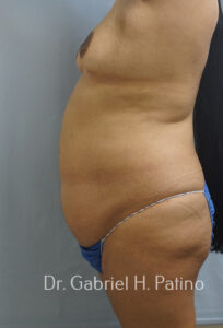  Before and After Cosmetic Surgery in Oakland, CA 