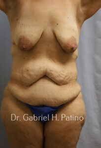  Before and After Cosmetic Surgery in Oakland, CA 