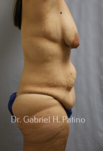  Before and After Cosmetic Surgery in Oakland, CA 