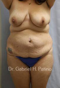  Before and After Cosmetic Surgery in Oakland, CA 