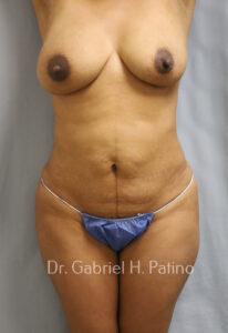  Before and After Cosmetic Surgery in Oakland, CA 