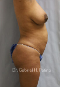  Before and After Cosmetic Surgery in Oakland, CA 