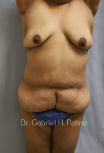  Before and After Cosmetic Surgery in Oakland, CA 