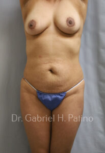  Before and After Cosmetic Surgery in Oakland, CA 