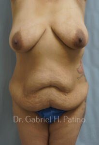  Before and After Cosmetic Surgery in Oakland, CA 