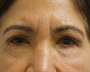  Before and After Cosmetic Surgery in Oakland, CA 