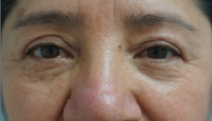  Before and After Cosmetic Surgery in Oakland, CA 