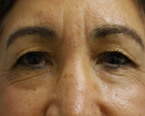  Before and After Cosmetic Surgery in Oakland, CA 