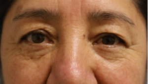 Before and After Cosmetic Surgery in Oakland, CA 