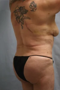  Before and After Cosmetic Surgery in Oakland, CA 