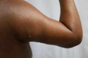  Before and After Cosmetic Surgery in Oakland, CA 