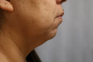  Before and After Cosmetic Surgery in Oakland, CA 